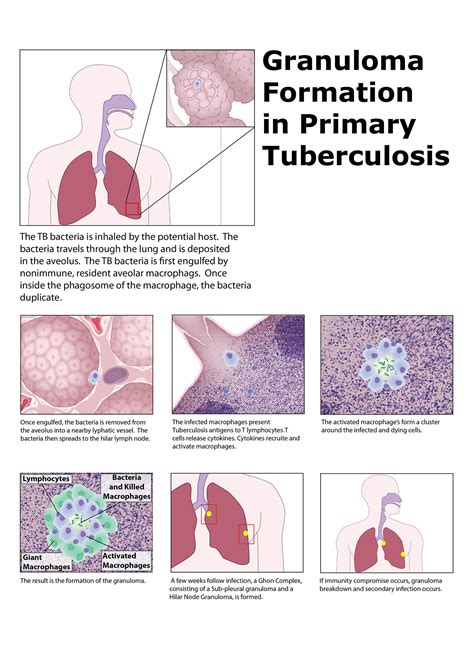 Tuberculosis Poster :: Behance