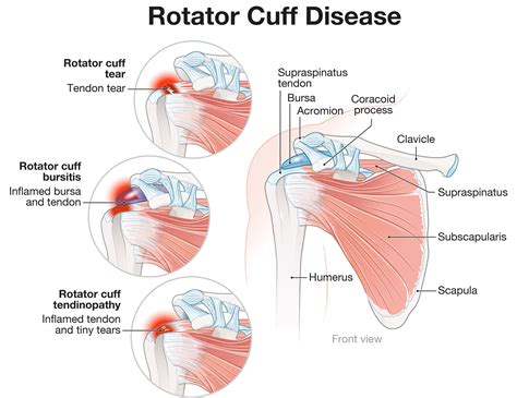 Rotator cuff tear conservative treatments and injections - Joint Rehab ...