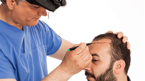 Best Hair Transplant Surgery in Delhi | Sama Hospital