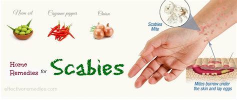 Top 20 Natural Home Remedies For Scabies Treatment In Humans