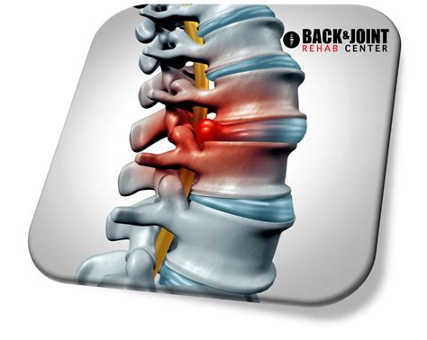 herniated disc, disc herniation, chiropractor, lower back pain, therapy ...