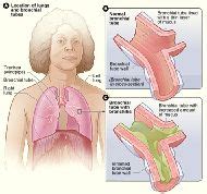 Bronchitis - New World Encyclopedia