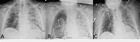 Anterior-Posterior chest x-ray on admission A). Anterior-Posterior ...