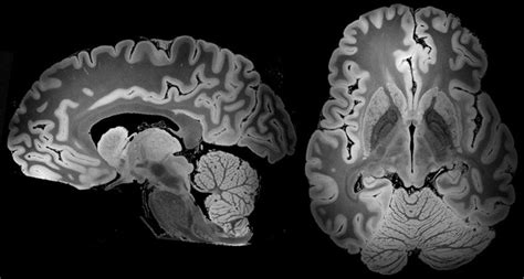 Brain Mri Scan 3d