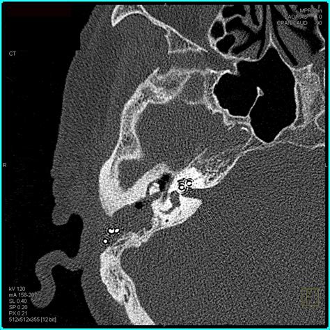 High Resolution Imaging of the Temporal Bone - Musculoskeletal Case ...