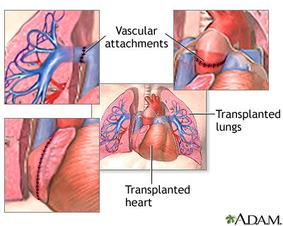 Heart-lung transplant - series—Procedure, part 2: MedlinePlus Medical Encyclopedia