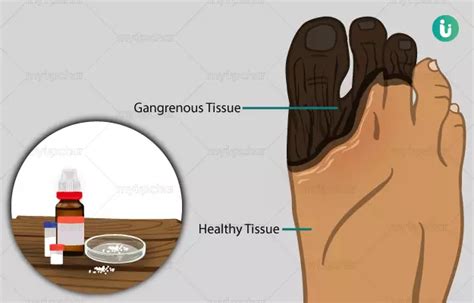 Homeopathic Treatment, Medicines, Remedies for Gangrene: Types, Effectiveness, and Risks