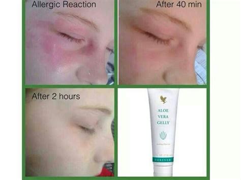 Got irritation or swelling on skin, try aloe vera gelly | Forever ...