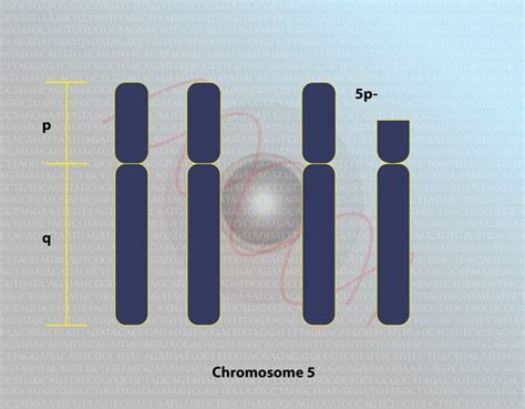 Cri-du-chat syndrome: MedlinePlus Genetics