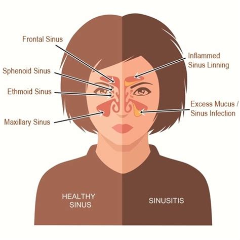 Are you suffering from allergies or sinusitis? | Health24