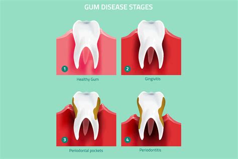 Fun Info About How To Fight Gingivitis - Strangertourist2