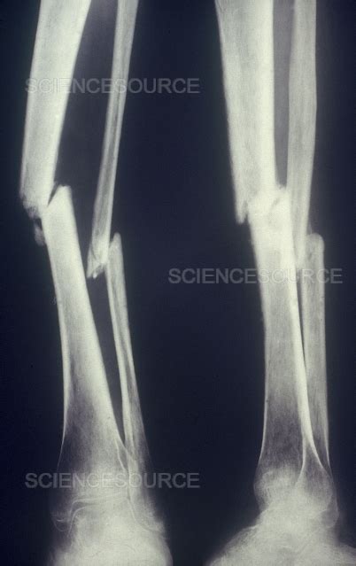 Broken Leg X-Ray | Stock Image - Science Source Images