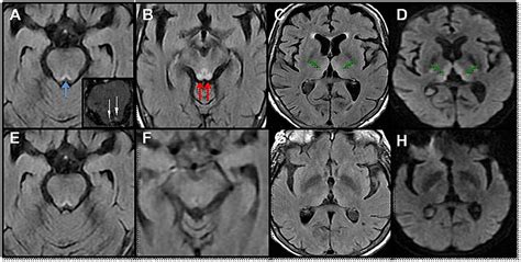 Wernicke’s Encephalopathy | Cureus