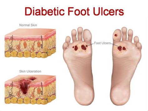 Chronic Diabetic Foot Ulcers – Jewish Chicken Ranchers