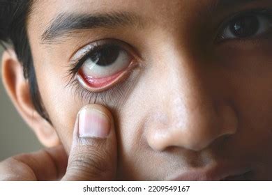 728 Anemia asian Gambar, Foto Stok & Vektor | Shutterstock