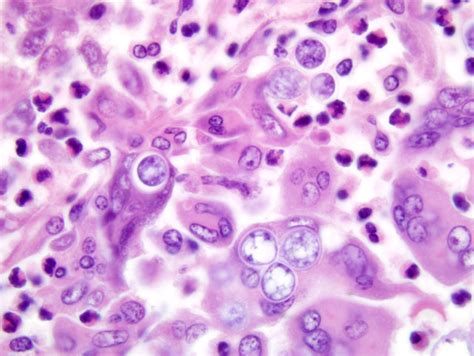 Blastomycosis Histology