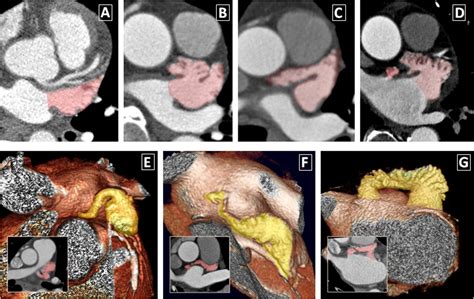 Left atrial appendage: anatomy and imaging landmarks pertinent to percutaneous transcatheter ...