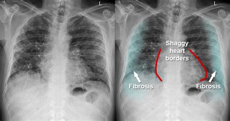 Fibrosis Chest X Ray