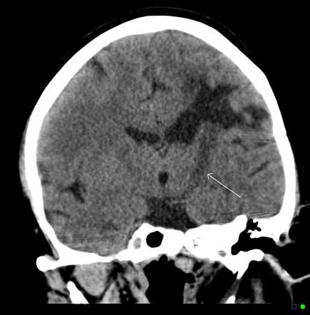 Wallerian degeneration - CT findings | Image | Radiopaedia.org