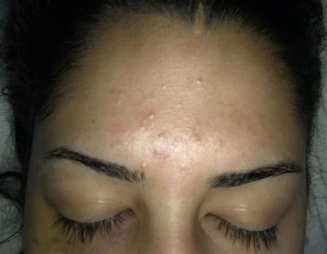 Colorless bumps on forehead - Beauty Insider Community