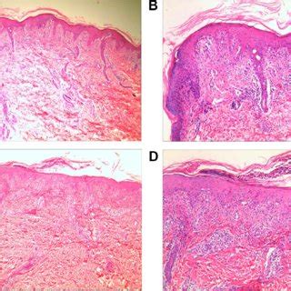 H&E staining shows PLEVA-like features before diagnosis of syphilis. (A... | Download Scientific ...