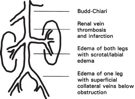 Inferior Vena Cava | Radiology Key