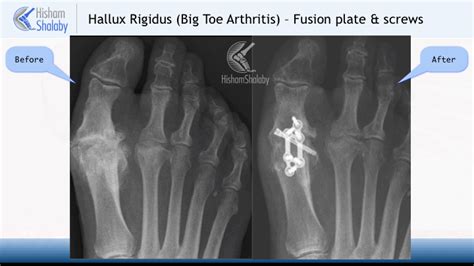 Big Toe Fusion - Orthopaedic Foot & Ankle Surgeon - Edinburgh - Mr. H ...