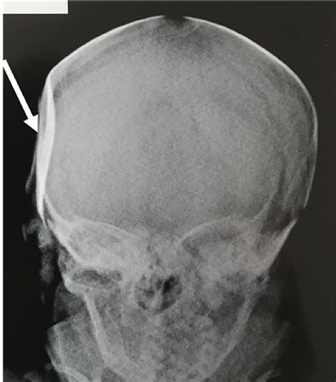 Cureus | Closed Depressed Skull Fracture in Childhood Reduced with ...