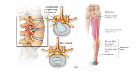 Radiculopathy Treatment - inline physio.