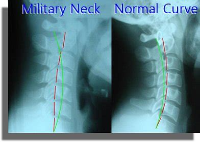 Hasil Rontgen Cervical - Tanya Alodokter