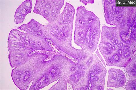 squamous papilloma pathology