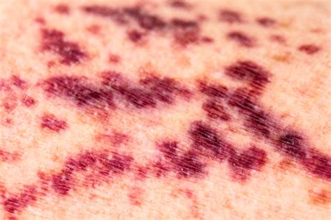 Royalty Free Skin Rash Pictures, Images and Stock Photos - iStock