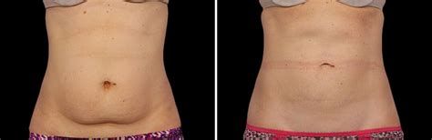 CoolSculpting Before and After Images | Real Patient Results