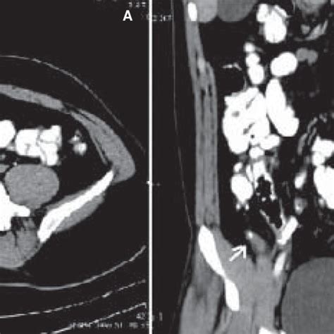 (A, B): Distal appendicitis. Contrast-enhanced axial CT scan (A) shows ...