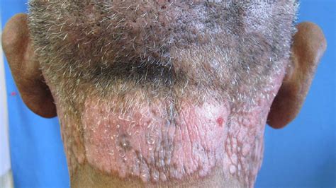 Hiv Rash Start