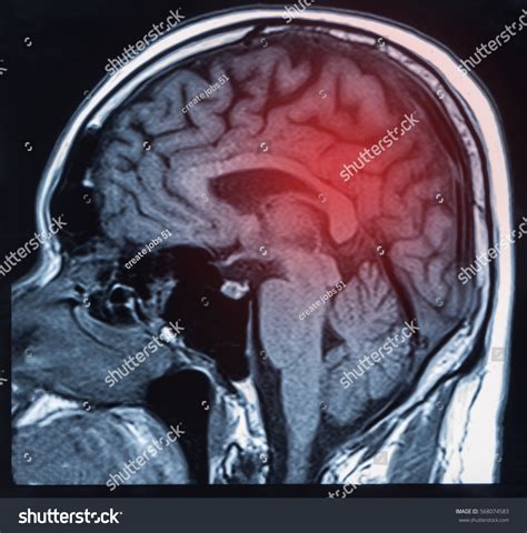 Mri Scan Brain Image Showing Result Stock Photo 568074583 | Shutterstock