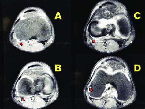 Popliteus Tendon Mri