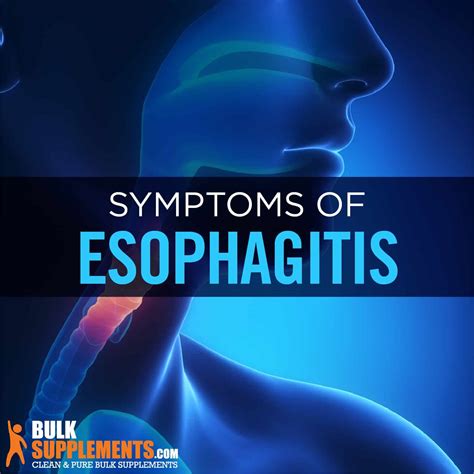 Esophagitis: Symptoms, Causes & Treatment by James Denlinger