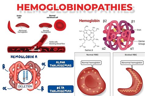 HEMOGLOBINOPATHIES: Types and Clinical Insights - Medical Laboratory Scientist MLS