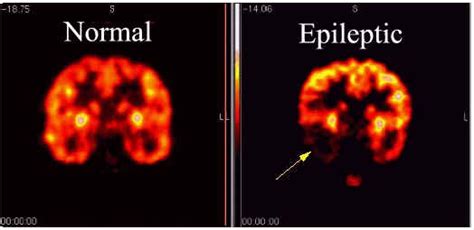 Epilepsy Diagnosis and Epilepsy Test - Health Normal