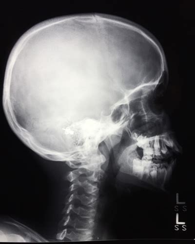 What is a Brain Xray? | Two Views