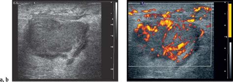 BI-RADS For Ultrasound | Radiology Key