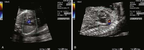 Patent Ductus Arteriosus Ultrasound Images