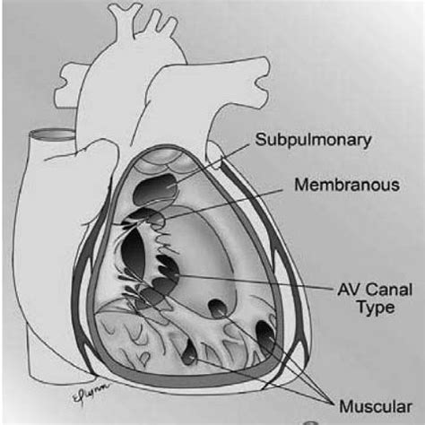 Echocardiography 2 weeks post catheterization showed coil in situ ...