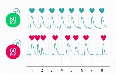 Normal Heart Rate Line