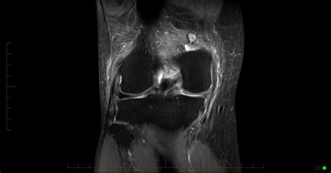 IMAGING GUIDED EUFLEXXA INJECTION FOR MANAGEMENT OF KNEE OSTEOARTHRITIS ...