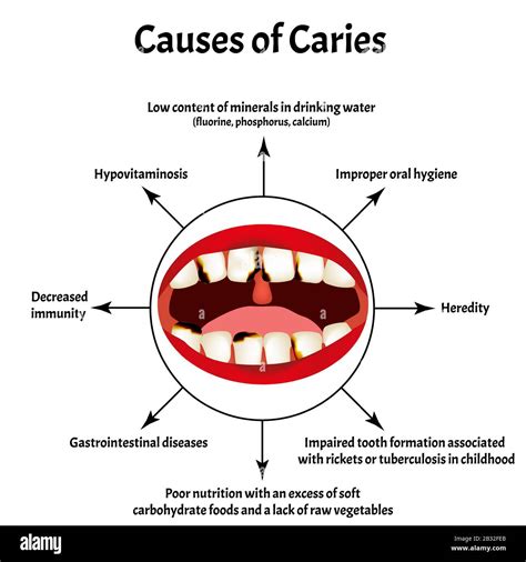 Causes of caries. Smell from the mouth. Halitosis. The structure of the ...