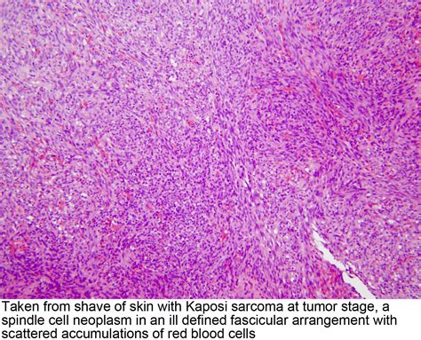 Pathology Outlines - Kaposi sarcoma