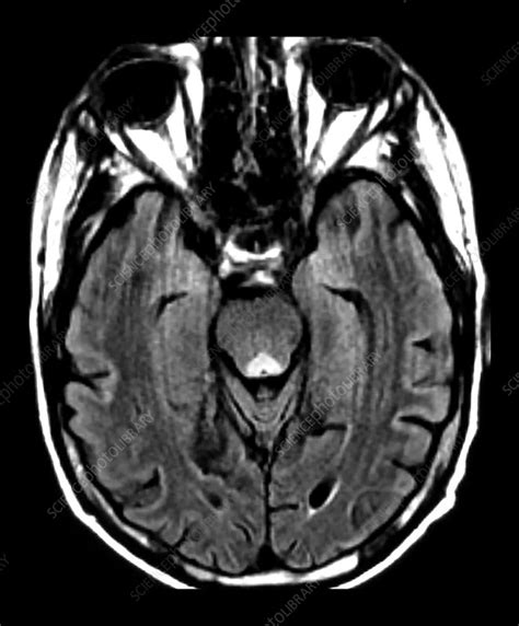 Wernicke's Encephalopathy on MRI - Stock Image - C043/0260 - Science ...