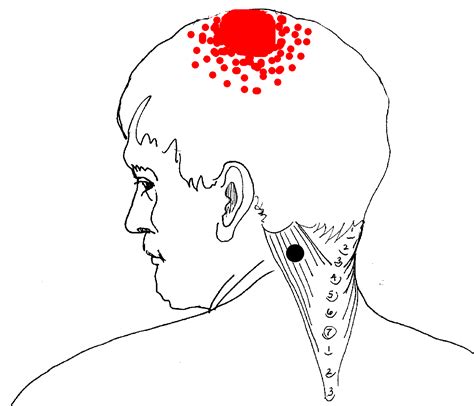 Common and rare diseases in head & neck: Pain in Head & Neck